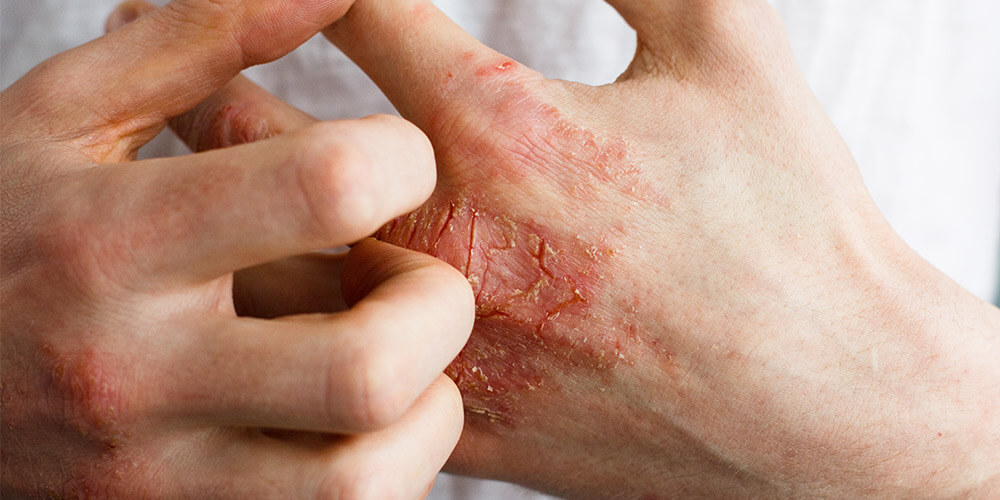 kožní dermatitida rukou jednorázové rukavice